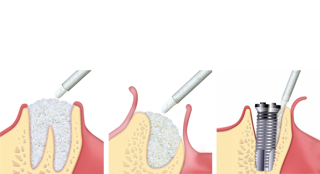 Xenograft benerstatning, GTO Osteobiol