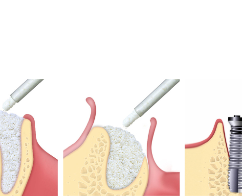 Xenograft benerstatning, GTO Osteobiol