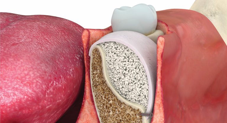 Osteobiol membraner. Lamina i bruk her